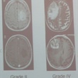 Radiotherapy and Pregnancy in the Presence of Low-Grade Gliomas