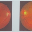 Automatic Screening Software Identifies Early Stages of Diabetic Retinopathy