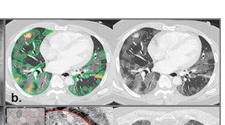 Fighting a Pandemic with Medical Imaging and Machine Learning: Lessons Learned from COVID-19