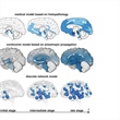 Multiscale Modeling of Dementia: From Proteins to Brain Dynamics